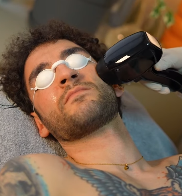 Yanak Bölgesi Lazer Epilasyon